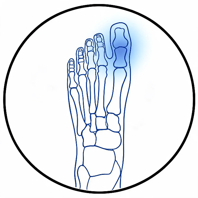Gout and pseudogout